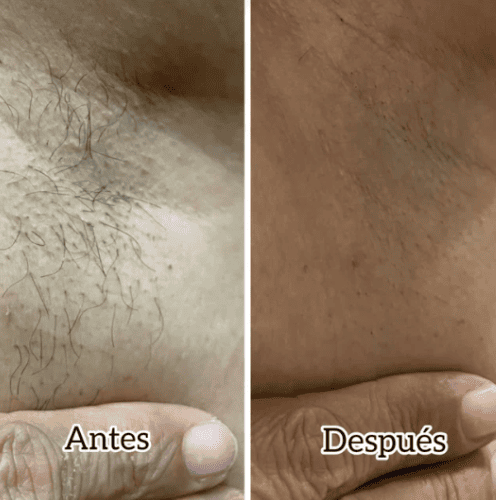 DermoLuz®- Previene irritaciones y reduce el cremiento del vello