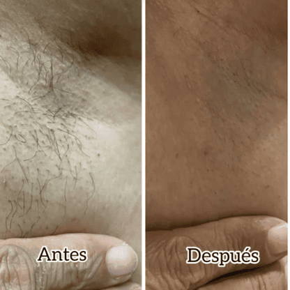 DermoLuz®- Previene irritaciones y reduce el cremiento del vello